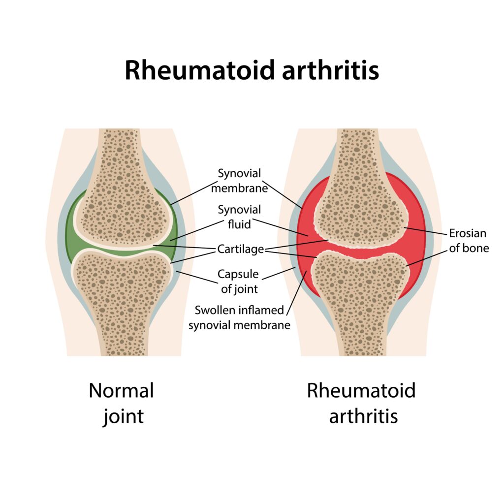Comparison of a healthy joint and rheumatoid arthritis joint inflammation by orthopedic specialist Gurgaon.